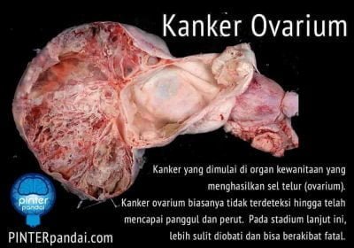 Kanker Ovarium Indung Telur Ciri Gejala Penyebab Pengobatan