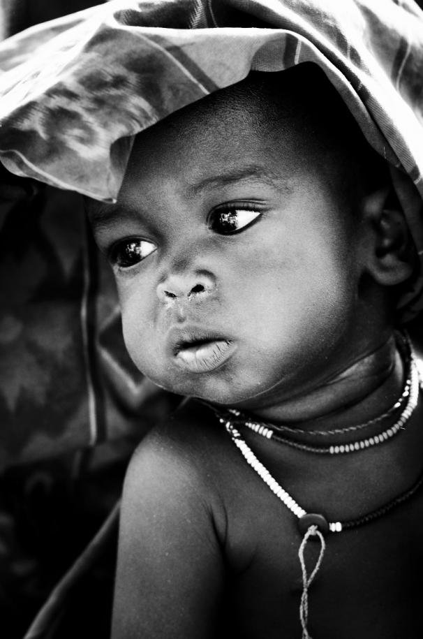 Komplikasi malaria Anak malaria-vulnerable