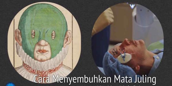 Cara Menyembuhkan Mata Juling (Strabismus)