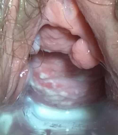 Penyebab infeksi jamur pada vagina