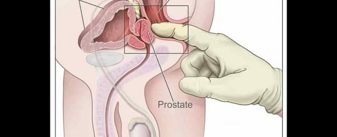 Penyakit kanker prostat