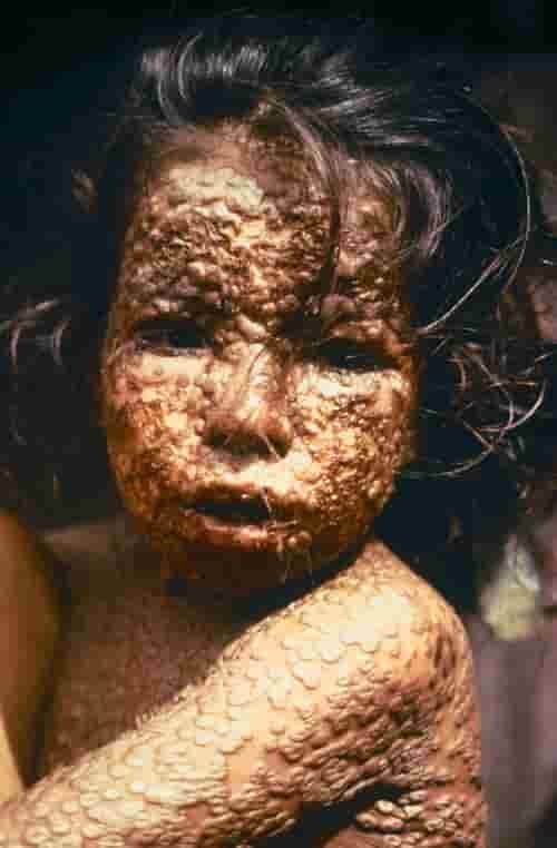 Anak terinfeksi oleh smallpox