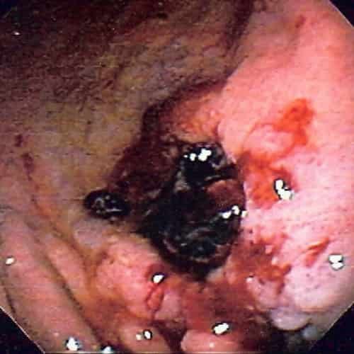 Tukak lambung gastric ulcer, salah satu penyebab muntah darah
