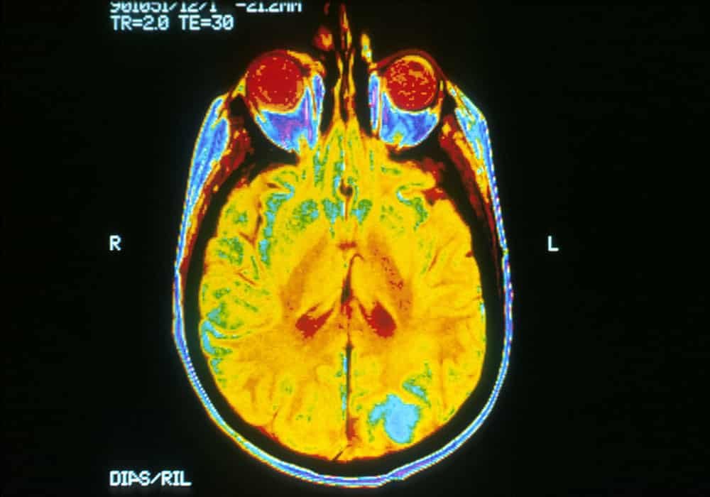 Fakta Kanker Otak Yang Mungkin Belum Anda Ketahui