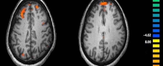 Skizofrenia adalah penyakit mental yang memengaruhi bagaimana seseorang berpikir atau merasa