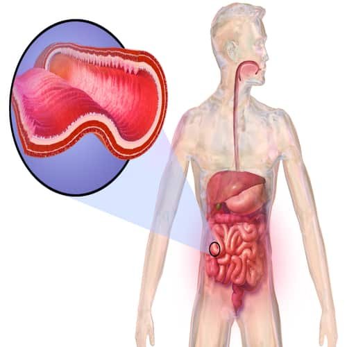 Penyakit radang usus kronis crohn
