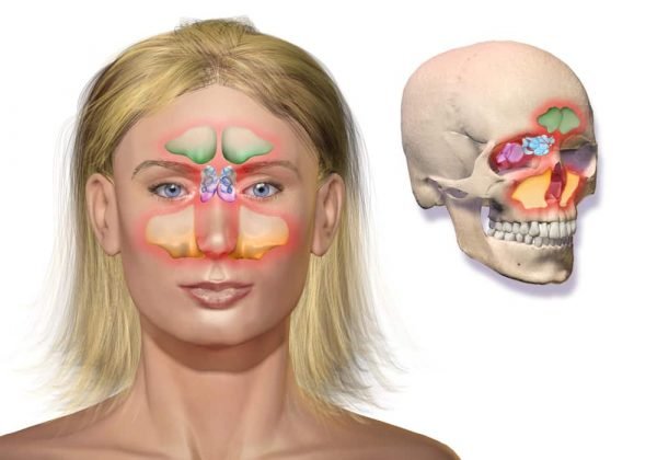 Terbaru 33 Gambar Penyakit Sinusitis - Riset