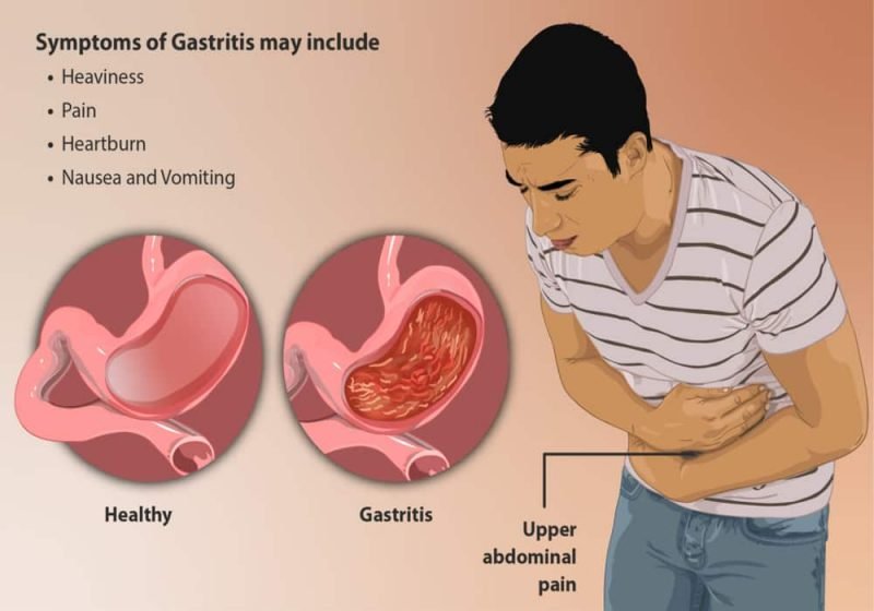 Gastritis Radang Lapisan Lambung Gejala Kronis Penyebab Obat