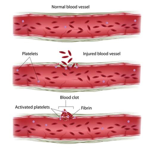 Bernard soulier syndrome pembekuan darah