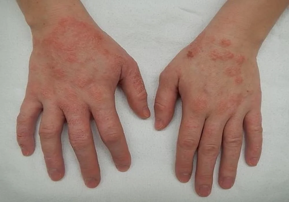 Alergi Kulit (skin allergy) Ciri-Ciri, Penyebab, Reaksi Alergi, Gejala dan Pengobatan
