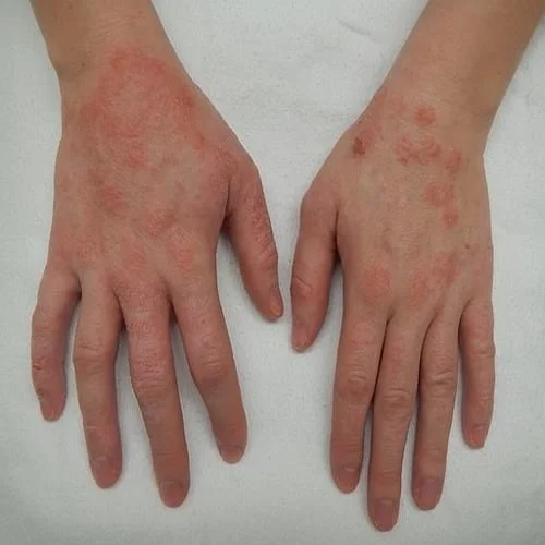 Eksema - Alergi Kulit (skin allergy) Ciri-Ciri, Penyebab, Reaksi Alergi, Gejala dan Pengobatan