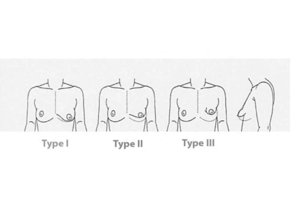 Payudara Tubular (Payudara berbonggol) | Tuberous breasts / Malformasi Payudara