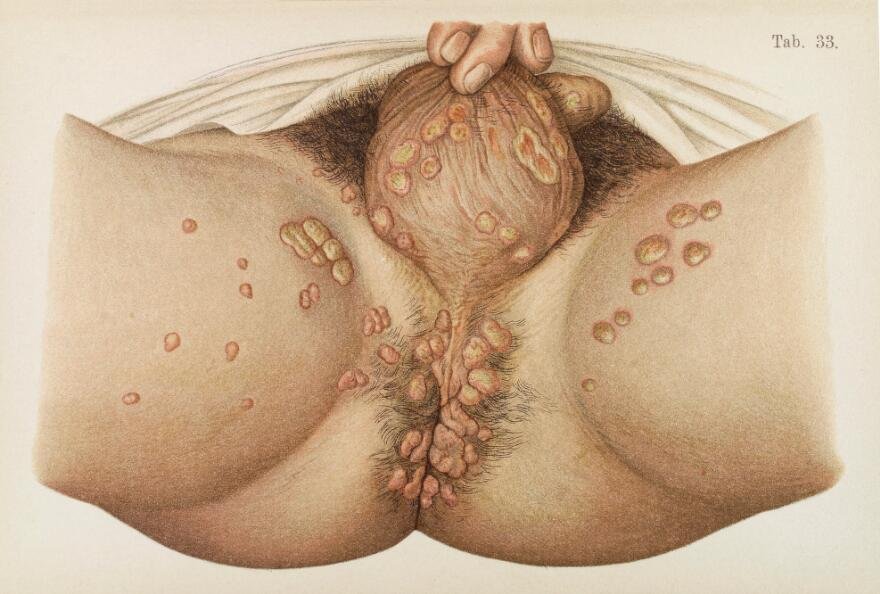 Ilustrasi menunjukkan kulit daerah skrotum dan perineum yang terkena penyakit sifilis
