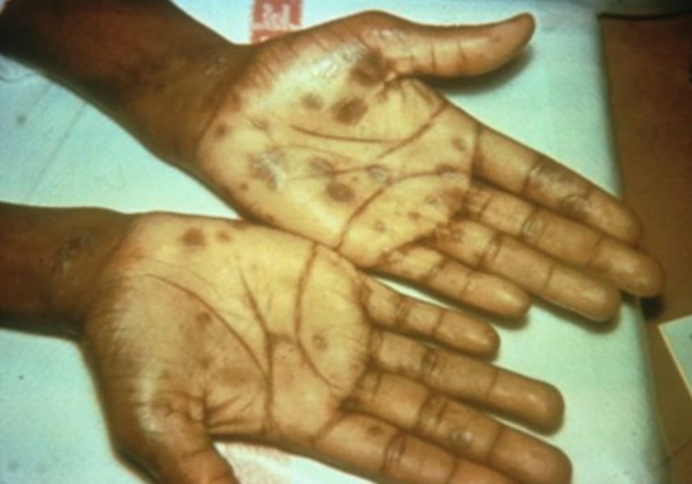 Presentasi khas sifilis sekunder dengan ruam di telapak tangan.