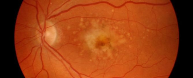 Macular degeneration penyakit retina