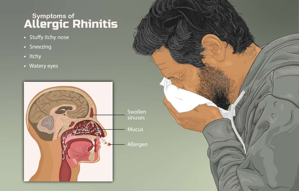Rinitis alergi
