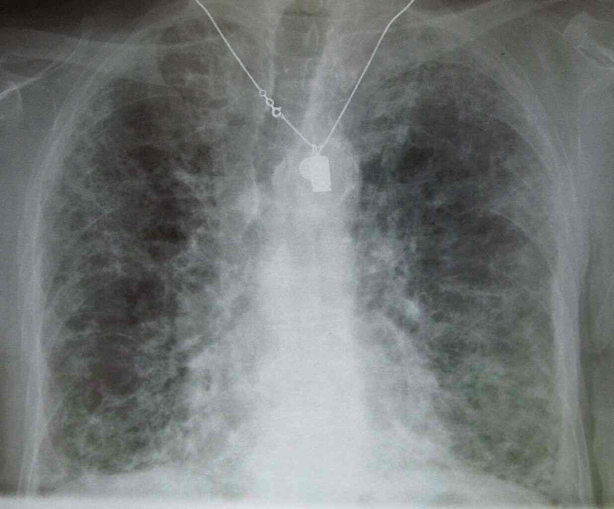 Fibrosis paru xray